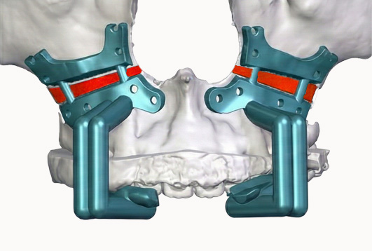 3D 수술 이미지 2