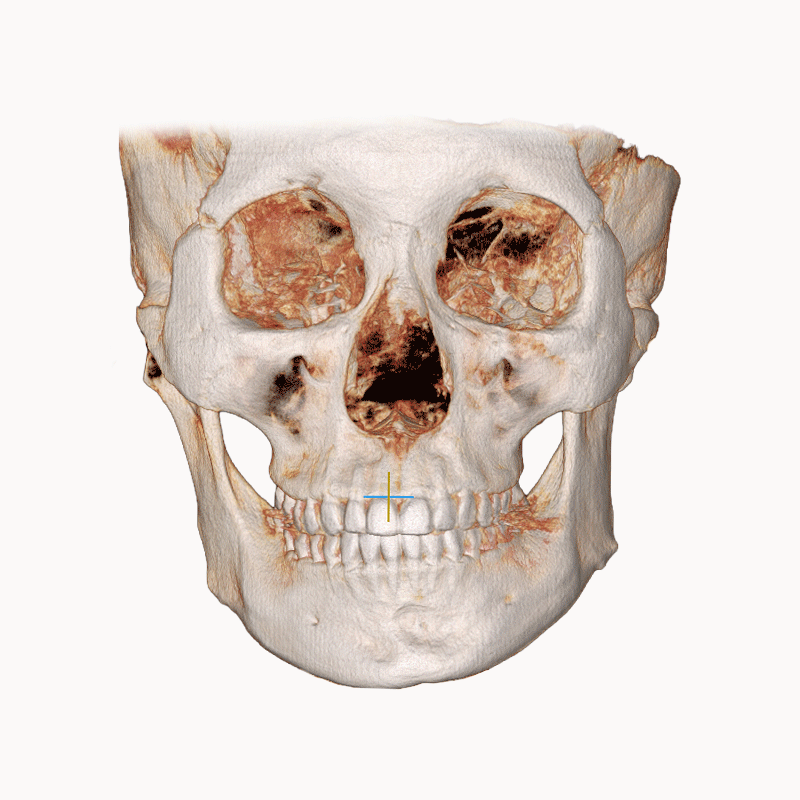 복합수술이 필요한 골격 문제