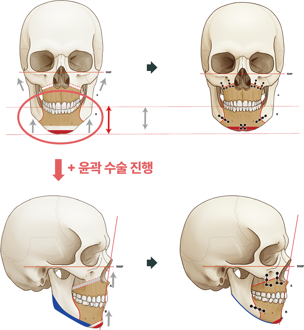 양악·윤곽 복합 수술 과정 도해