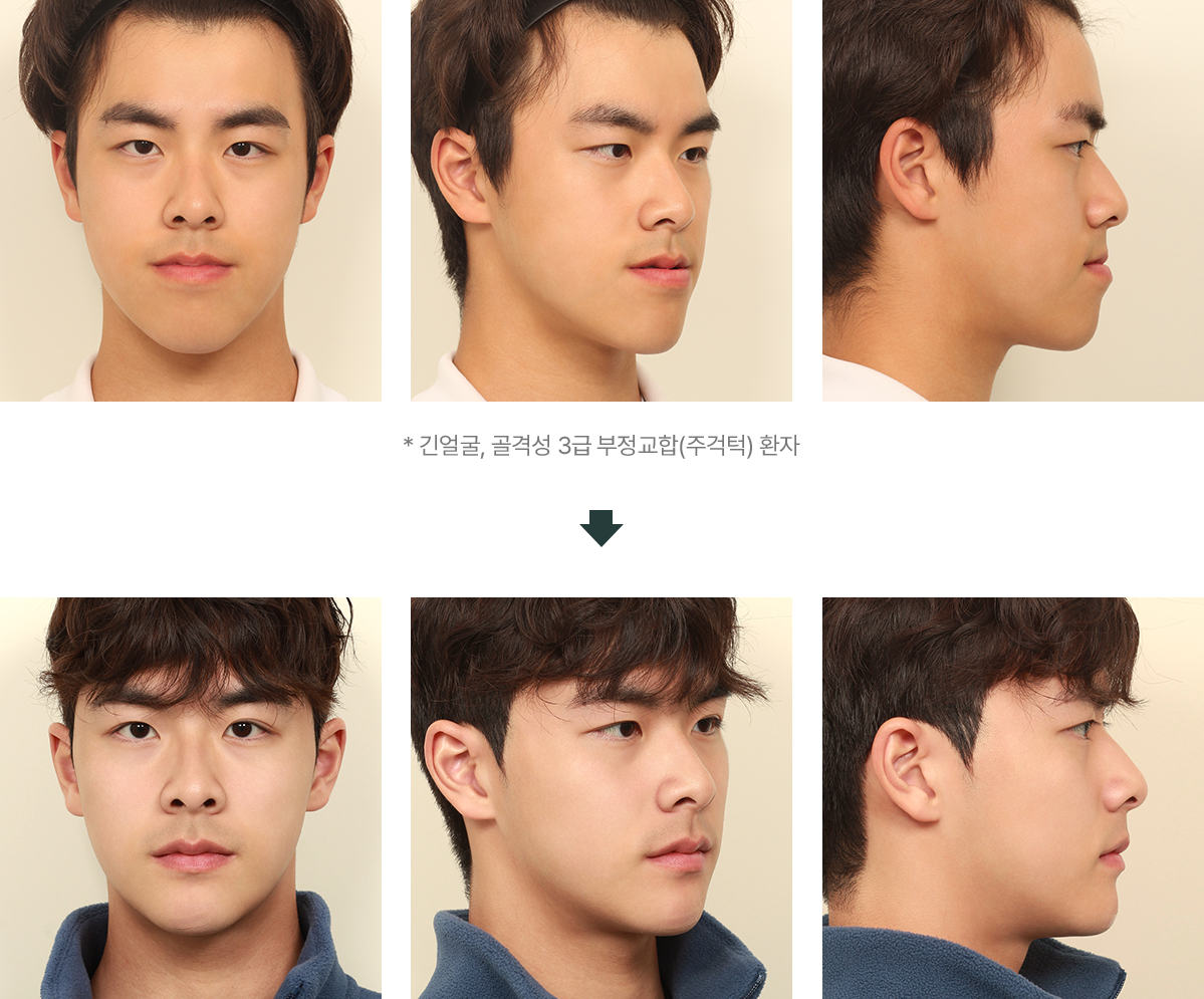 양악·윤곽 복합 수술 전후 사진 1