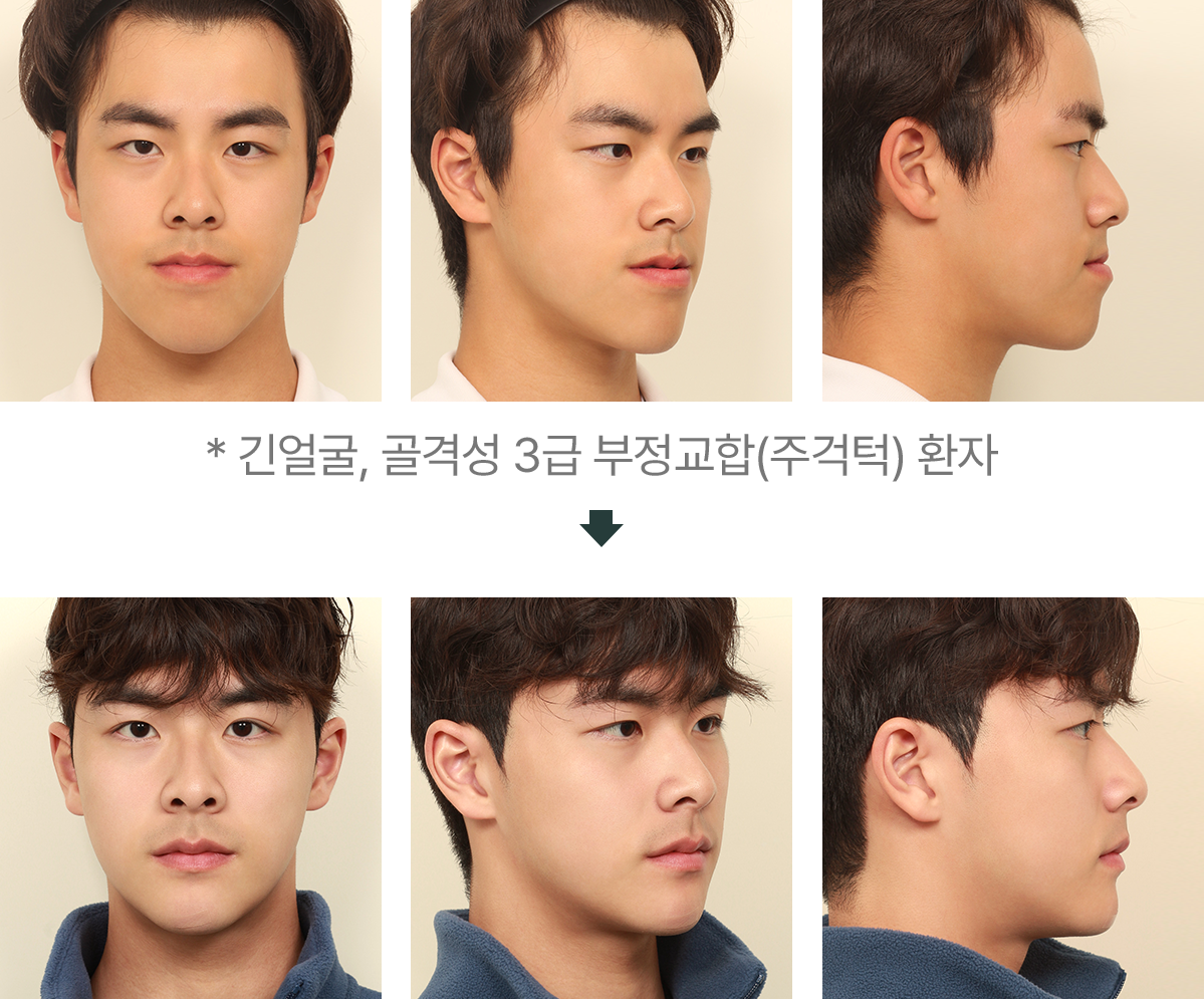 양악·윤곽 복합 수술 전후 사진 1