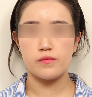 안면비대칭 사진 1