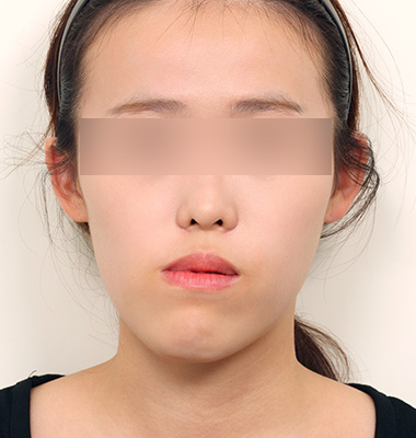 안면비대칭 사진 2