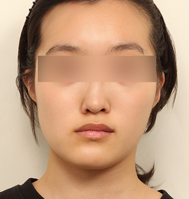 안면비대칭 사진 3
