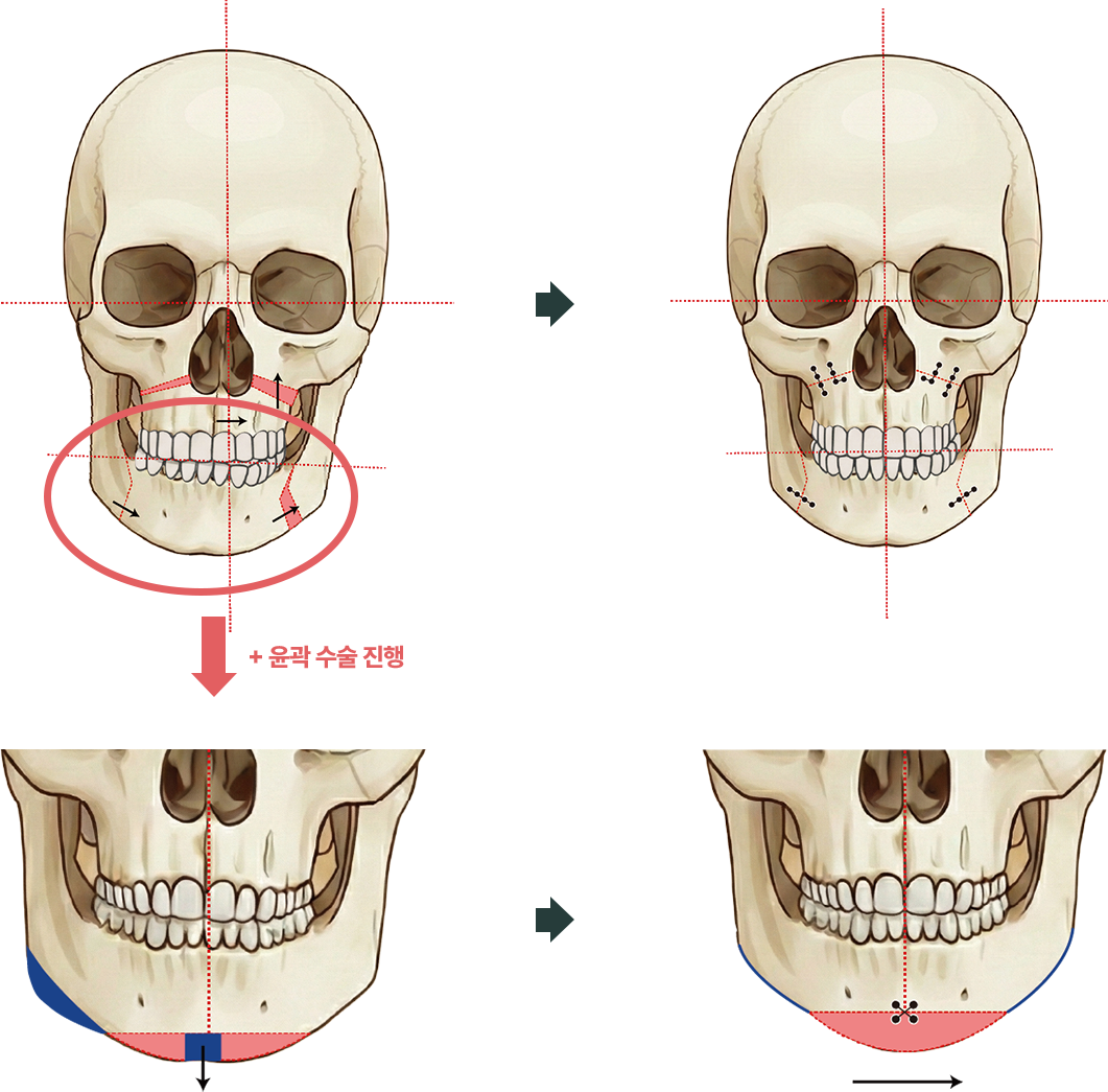 안면비대칭 수술방법 도해