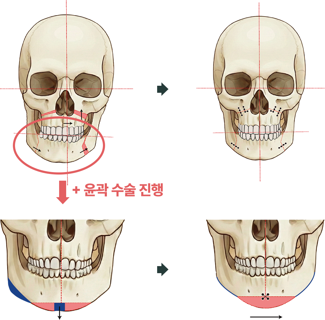 안면비대칭 수술방법 도해