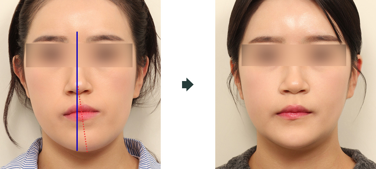 안면비대칭 수술 전 1