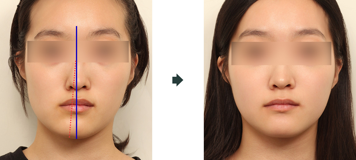 안면비대칭 수술 전 3