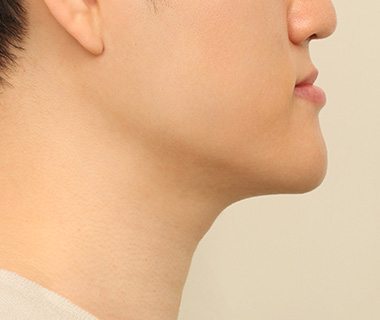 주걱턱 측면 사진