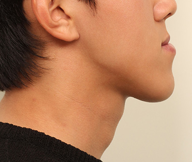 주걱턱 측면 사진 2