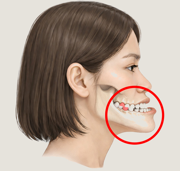 턱 전체의 돌출