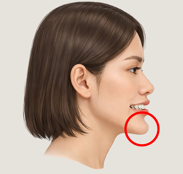 턱 끝의 돌출