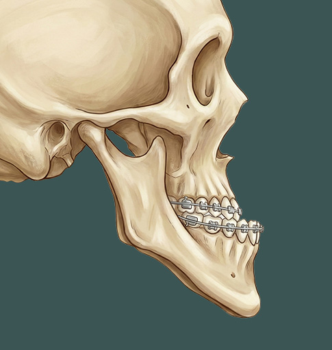 턱 전체의 문제로 인한 주걱턱