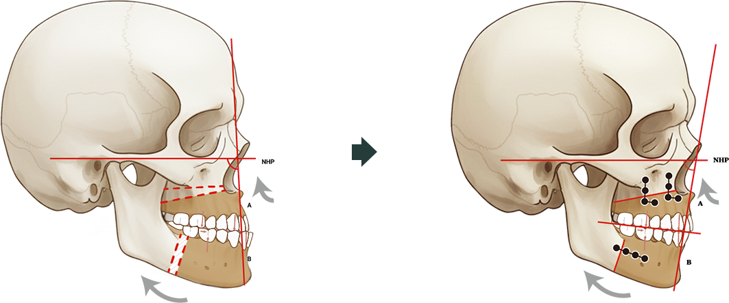 턱교정 수술 도해