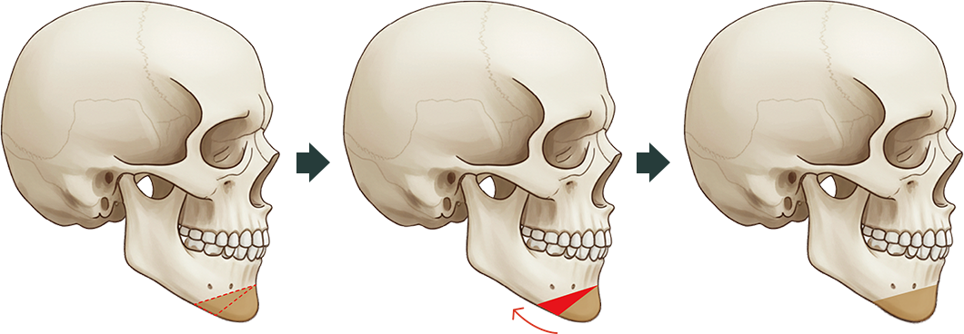 턱 끝 수술 도해