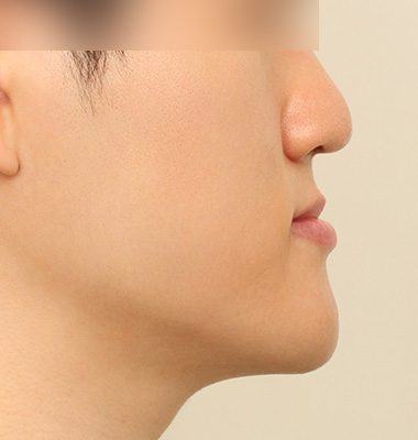 주걱턱 수술 전 1