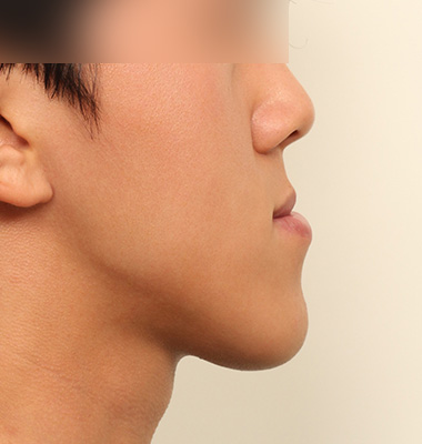 주걱턱 수술 전 2