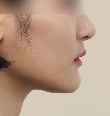 주걱턱 수술 전 3