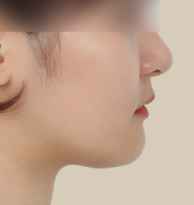 주걱턱 수술 후 3