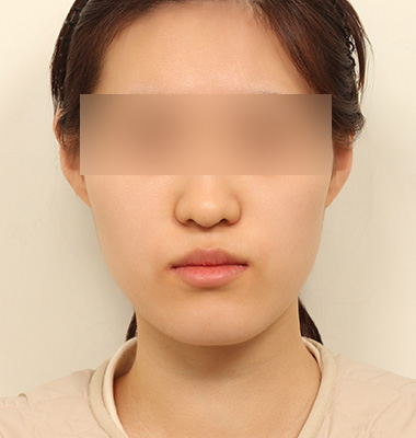 긴얼굴 수술 전후 사진 1