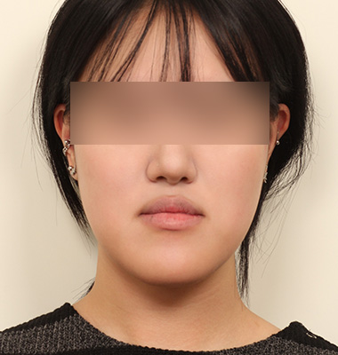 긴얼굴 수술 전후 사진 2