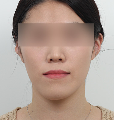 긴얼굴 수술 전후 사진 3