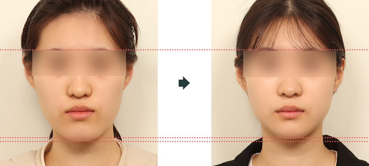 긴얼굴 수술 전후사진 1