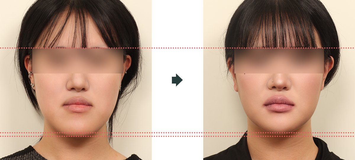 긴얼굴 수술 전후사진 2