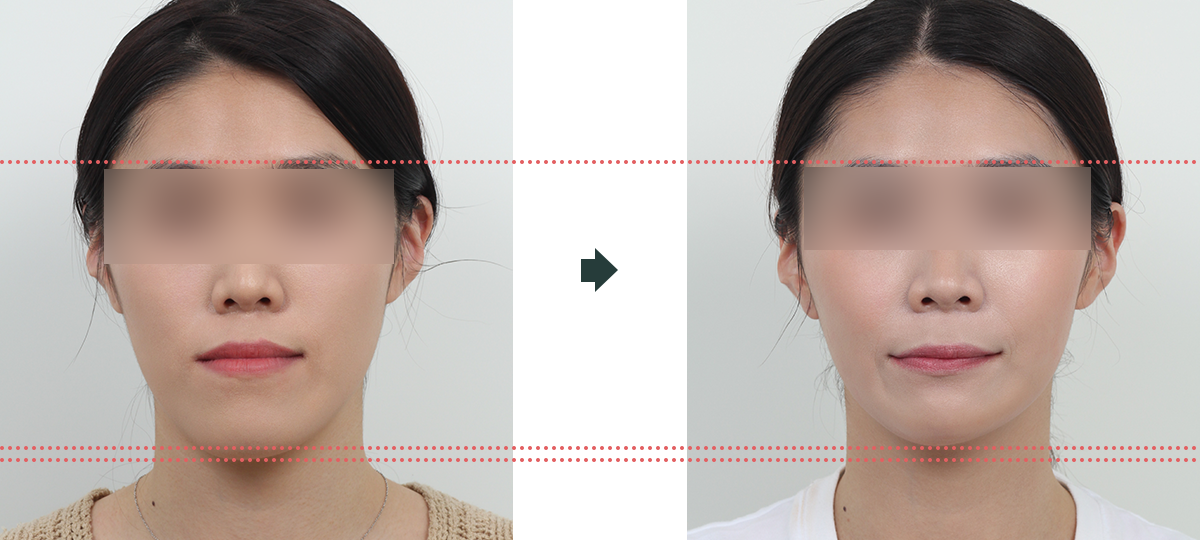 긴얼굴 수술 전후사진 3