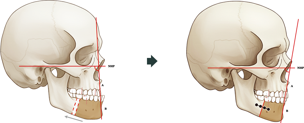 SSRO (시상분할 하악절골술) 수술 도해