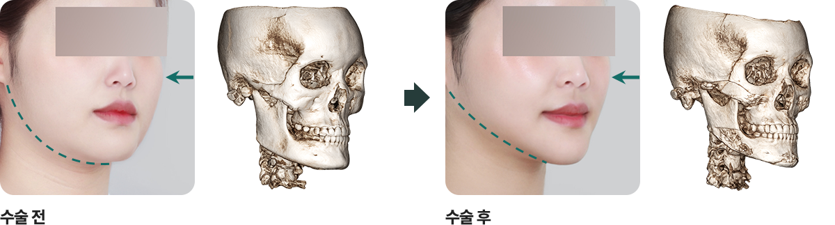 안면윤곽3종 전후사진 1