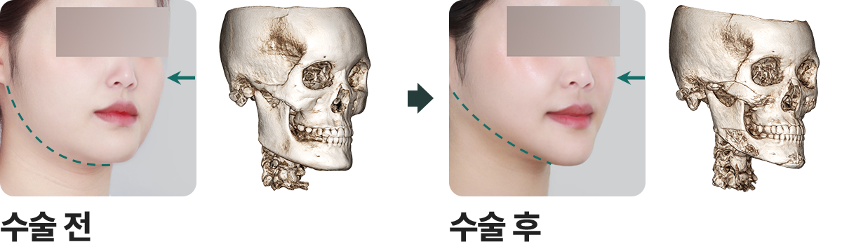 안면윤곽3종 전후사진 1