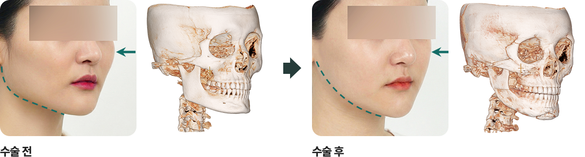 안면윤곽3종 전후사진 2