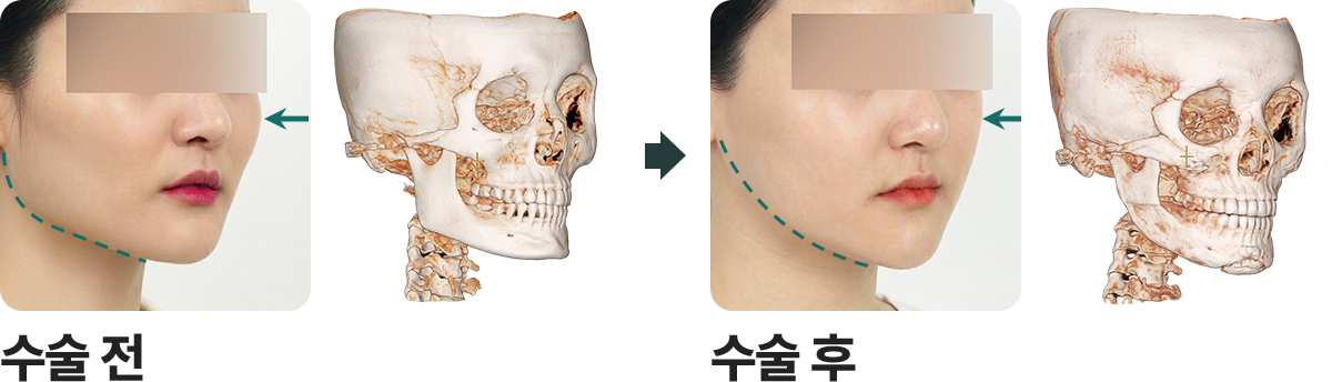 안면윤곽3종 전후사진 2