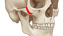턱교정 수술 도해