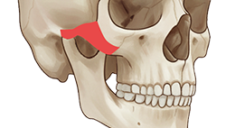 턱교정 수술 도해