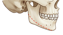 턱교정 수술 도해