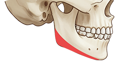 턱교정 수술 도해