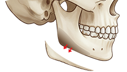 턱교정 수술 도해