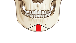 턱교정 수술 도해