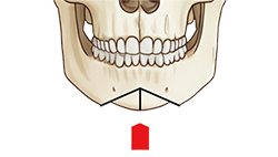 턱교정 수술 도해