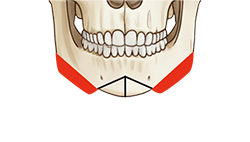 턱교정 수술 도해