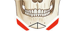 턱교정 수술 도해