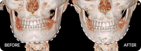 윤곽3종 수술 전후 뼈사진 1