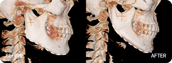 윤곽3종 수술 전후 뼈사진 2