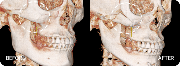 윤곽3종 수술 전후 뼈사진 3