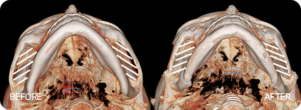 윤곽3종 수술 전후 뼈사진 4
