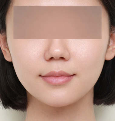 브이라인 수술 후 사진
