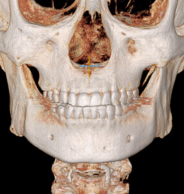 브이라인 수술 전 사진