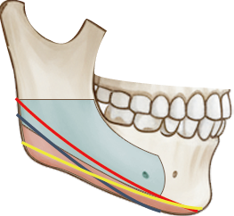 긴곡선 절제 도해